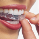 Invisalign-Top